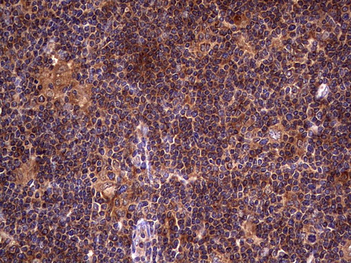 DOCK8 Antibody - IHC of paraffin-embedded Human lymphoma tissue using anti-DOCK8 mouse monoclonal antibody. (Heat-induced epitope retrieval by 1 mM EDTA in 10mM Tris, pH8.5, 120°C for 3min).