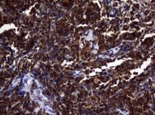DOCK8 Antibody - IHC of paraffin-embedded Human lymphoma tissue using anti-DOCK8 mouse monoclonal antibody. (Heat-induced epitope retrieval by 1 mM EDTA in 10mM Tris, pH9.0, 120°C for 3min).