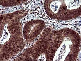 DOCK8 Antibody - IHC of paraffin-embedded Carcinoma of Human pancreas tissue using anti-DOCK8 mouse monoclonal antibody. (Heat-induced epitope retrieval by 10mM citric buffer, pH6.0, 120°C for 3min).