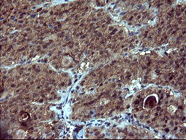 DOCK8 Antibody - IHC of paraffin-embedded Carcinoma of Human thyroid tissue using anti-DOCK8 mouse monoclonal antibody. (Heat-induced epitope retrieval by 10mM citric buffer, pH6.0, 120°C for 3min).