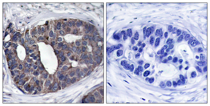 DOK1 Antibody - Immunohistochemistry analysis of paraffin-embedded human breast carcinoma tissue, using p62 Dok Antibody. The picture on the right is blocked with the synthesized peptide.