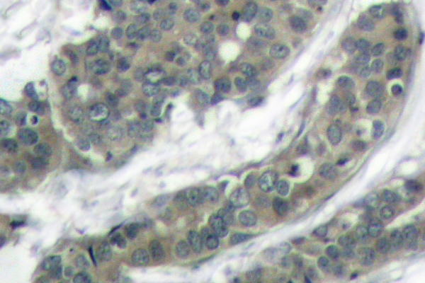 DOK1 Antibody - IHC of Dok-1 (R392) pAb in paraffin-embedded human breast carcinoma tissue.