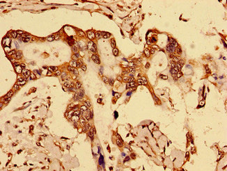 DOK1 Antibody - Immunohistochemistry of paraffin-embedded human breast cancer using DOK1 Antibody at dilution of 1:100