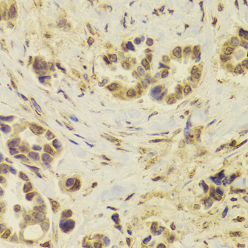 DOK1 Antibody - Immunohistochemistry of paraffin-embedded Human mammary cancer tissue.