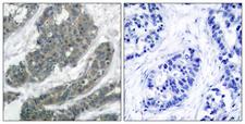 DOK1 Antibody - Peptide - + Immunohistochemical analysis of paraffin-embedded human breast carcinoma tissue using p62Dok (Ab-398) antibody.
