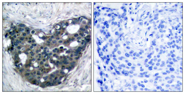 DOK2 Antibody - Immunohistochemistry analysis of paraffin-embedded human breast carcinoma tissue, using p56 Dok-2 Antibody. The picture on the right is blocked with the synthesized peptide.