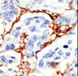 DOK2 Antibody - Formalin-fixed and paraffin-embedded human cancer tissue reacted with the primary antibody, which was peroxidase-conjugated to the secondary antibody, followed by DAB staining. This data demonstrates the use of this antibody for immunohistochemistry; clinical relevance has not been evaluated. BC = breast carcinoma; HC = hepatocarcinoma.