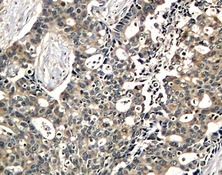 DOK2 Antibody - Immunohistochemical analysis of paraffin-embedded human breast carcinoma tissue.