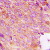 DOK2 Antibody - Immunohistochemical analysis of DOK2 (pY299) staining in human breast cancer formalin fixed paraffin embedded tissue section. The section was pre-treated using heat mediated antigen retrieval with sodium citrate buffer (pH 6.0). The section was then incubated with the antibody at room temperature and detected using an HRP conjugated compact polymer system. DAB was used as the chromogen. The section was then counterstained with hematoxylin and mounted with DPX.
