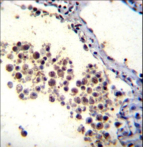 DOK3 Antibody - DOK3 Antibody immunohistochemistry of formalin-fixed and paraffin-embedded human lung tissue followed by peroxidase-conjugated secondary antibody and DAB staining.