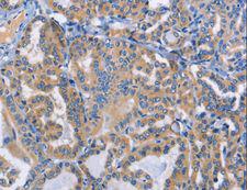 DOK4 Antibody - Immunohistochemistry of paraffin-embedded Human cervical cancer using DOK4 Polyclonal Antibody at dilution of 1:50.