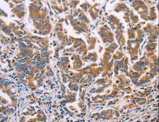 DOK4 Antibody - Immunohistochemistry of paraffin-embedded Human liver cancer using DOK4 Polyclonal Antibody at dilution of 1:60.