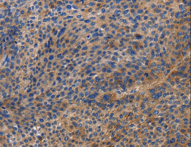 DOK4 Antibody - Immunohistochemistry of paraffin-embedded Human liver cancer using DOK4 Polyclonal Antibody at dilution of 1:60.