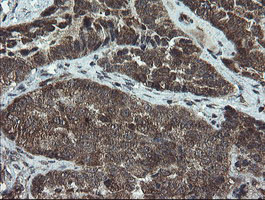 DOK7 Antibody - IHC of paraffin-embedded Adenocarcinoma of Human ovary tissue using anti-DOK7 mouse monoclonal antibody. (Heat-induced epitope retrieval by 10mM citric buffer, pH6.0, 100C for 10min).