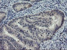 DOK7 Antibody - IHC of paraffin-embedded Adenocarcinoma of Human endometrium tissue using anti-DOK7 mouse monoclonal antibody. (Heat-induced epitope retrieval by 10mM citric buffer, pH6.0, 100C for 10min).