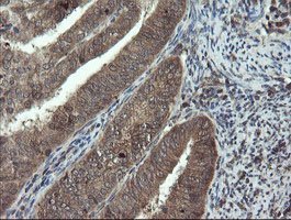 DOK7 Antibody - IHC of paraffin-embedded Adenocarcinoma of Human endometrium tissue using anti-DOK7 mouse monoclonal antibody. (Heat-induced epitope retrieval by 10mM citric buffer, pH6.0, 100C for 10min).