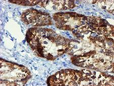 DOK7 Antibody - IHC of paraffin-embedded Adenocarcinoma of Human ovary tissue using anti-DOK7 mouse monoclonal antibody. (Heat-induced epitope retrieval by 10mM citric buffer, pH6.0, 100C for 10min).
