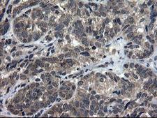 DOK7 Antibody - IHC of paraffin-embedded Adenocarcinoma of Human ovary tissue using anti-DOK7 mouse monoclonal antibody.