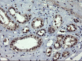 DOK7 Antibody - IHC of paraffin-embedded Carcinoma of Human thyroid tissue using anti-DOK7 mouse monoclonal antibody.