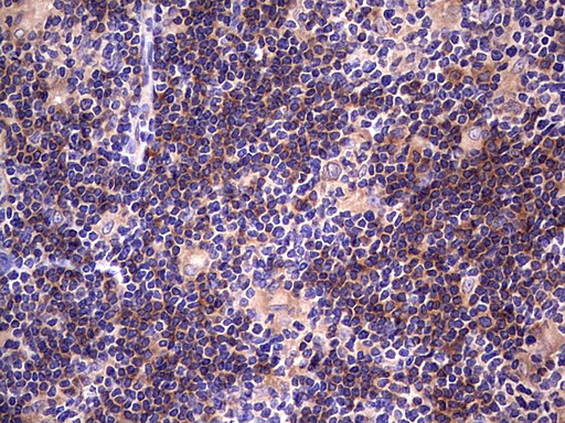 DOT1L / DOT1 Antibody - IHC of paraffin-embedded Human lymphoma tissue using anti-DOT1L mouse monoclonal antibody. (Heat-induced epitope retrieval by 1 mM EDTA in 10mM Tris, pH8.5, 120°C for 3min).