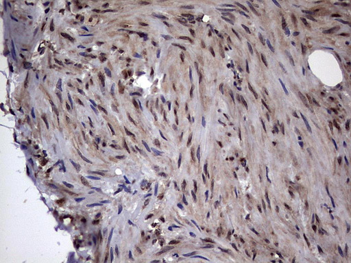 DOT1L / DOT1 Antibody - IHC of paraffin-embedded Carcinoma of Human kidney tissue using anti-DOT1L mouse monoclonal antibody. (Heat-induced epitope retrieval by 1 mM EDTA in 10mM Tris, pH8.5, 120°C for 3min).