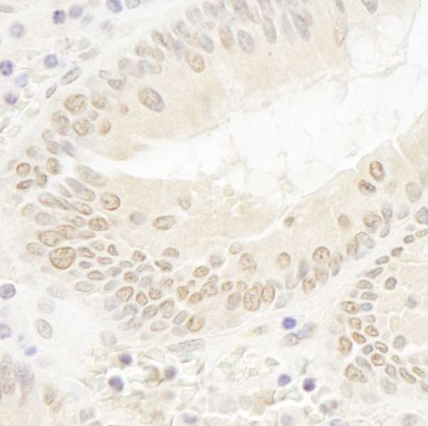 DOT1L / DOT1 Antibody - Detection of Human DOT1L by Immunohistochemistry. Sample: FFPE section of human colon carcinoma. Antibody: Affinity purified rabbit anti-DOT1L used at a dilution of 1:100. Epitope Retrieval Buffer-High pH (IHC-101J) was substituted for Epitope Retrieval Buffer-Reduced pH.