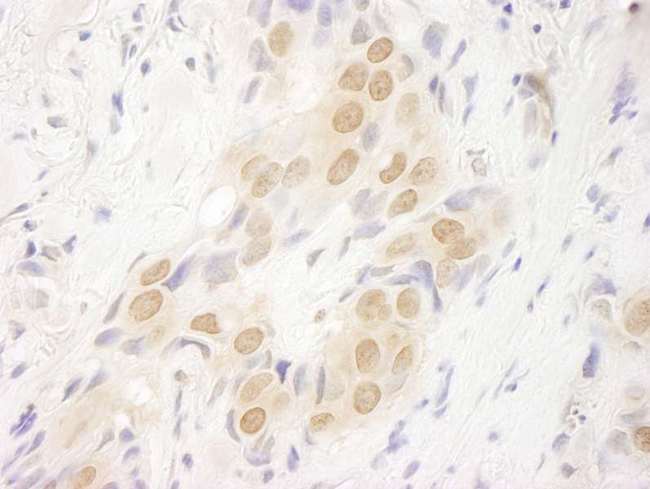 DOT1L / DOT1 Antibody - Detection of Human DOT1L by Immunohistochemistry. Sample: FFPE section of human breast carcinoma. Antibody: Affinity purified rabbit anti-DOT1L used at a dilution of 1:100. Epitope Retrieval Buffer-High pH (IHC-101J) was substituted for Epitope Retrieval Buffer-Reduced pH.