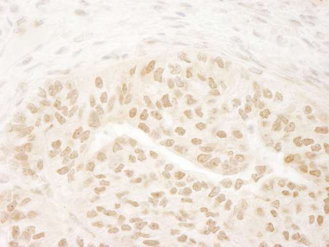 DOT1L / DOT1 Antibody - Detection of Human DOT1L by Immunohistochemistry. Sample: FFPE section of human lung carcinoma. Antibody: Affinity purified rabbit anti-DOT1L used at a dilution of 1:200 (1 Detection: DAB.