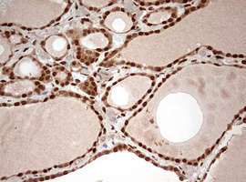 DOT1L / DOT1 Antibody - IHC of paraffin-embedded Human thyroid tissue using anti-DOT1L mouse monoclonal antibody. (Heat-induced epitope retrieval by 10mM citric buffer, pH6.0, 120°C for 3min).