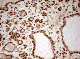 DOT1L / DOT1 Antibody - IHC of paraffin-embedded Carcinoma of Human thyroid tissue using anti-DOT1L mouse monoclonal antibody. (Heat-induced epitope retrieval by 10mM citric buffer, pH6.0, 120°C for 3min).