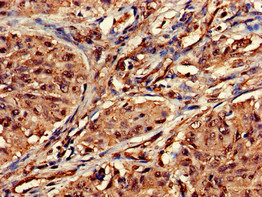 DOT1L / DOT1 Antibody - Immunohistochemistry of paraffin-embedded human lung cancer at dilution of 1:100