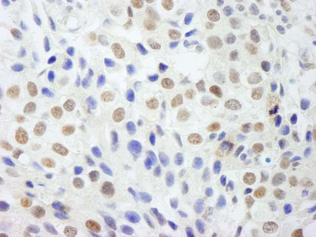 DP97 / DDX54 Antibody - Detection of Human DDX54 by Immunohistochemistry. Sample: FFPE section of human breast carcinoma. Antibody: Affinity purified rabbit anti-DDX54 used at a dilution of 1:250.