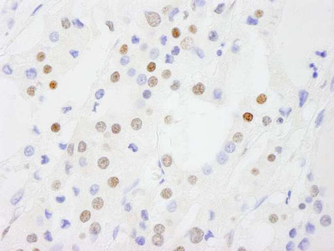 DP97 / DDX54 Antibody - Detection of Human DDX54 by Immunohistochemistry. Sample: FFPE section of human thyroid carcinoma. Antibody: Affinity purified rabbit anti-DDX54 used at a dilution of 1:250.