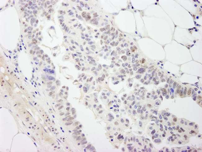 DP97 / DDX54 Antibody - Detection of Human DDX54 by Immunohistochemistry. Sample: FFPE section of human breast carcinoma. Antibody: Affinity purified rabbit anti-DDX54 used at a dilution of 1:200 (1 ug/ml). Detection: DAB.