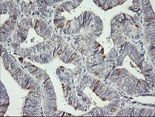 DPCD Antibody - IHC of paraffin-embedded Adenocarcinoma of Human endometrium tissue using anti-DPCD mouse monoclonal antibody. (Heat-induced epitope retrieval by 10mM citric buffer, pH6.0, 120°C for 3min).