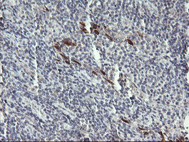 DPCD Antibody - IHC of paraffin-embedded Human lymphoma tissue using anti-DPCD mouse monoclonal antibody. (Heat-induced epitope retrieval by 10mM citric buffer, pH6.0, 120°C for 3min).