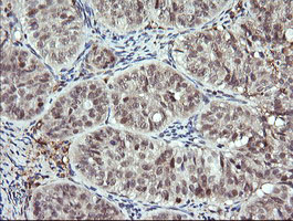 DPCD Antibody - IHC of paraffin-embedded Adenocarcinoma of Human ovary tissue using anti-DPCD mouse monoclonal antibody.