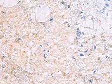 DPCD Antibody - Immunohistochemistry of paraffin-embedded Human gastric cancer tissue  using DPCD Polyclonal Antibody at dilution of 1:50(×200)