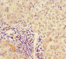 DPF1 / Neuro-D4 Antibody - Immunohistochemistry of paraffin-embedded human liver cancer at dilution 1:100