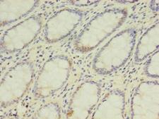 DPH2 Antibody - Immunohistochemistry of paraffin-embedded human colon cancer using DPH2 Antibody at dilution of 1:100