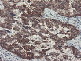 DPH2 Antibody - IHC of paraffin-embedded Adenocarcinoma of Human ovary tissue using anti-DPH2 mouse monoclonal antibody. (Heat-induced epitope retrieval by 10mM citric buffer, pH6.0, 100C for 10min).