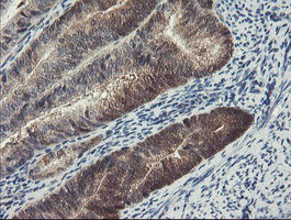 DPH2 Antibody - IHC of paraffin-embedded Adenocarcinoma of Human endometrium tissue using anti-DPH2 mouse monoclonal antibody. (Heat-induced epitope retrieval by 10mM citric buffer, pH6.0, 100C for 10min).
