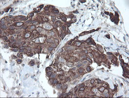 DPH2 Antibody - IHC of paraffin-embedded Adenocarcinoma of Human breast tissue using anti-DPH2 mouse monoclonal antibody.