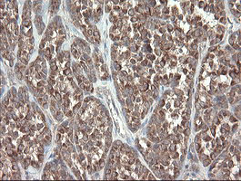 DPH2 Antibody - IHC of paraffin-embedded Carcinoma of Human thyroid tissue using anti-DPH2 mouse monoclonal antibody.