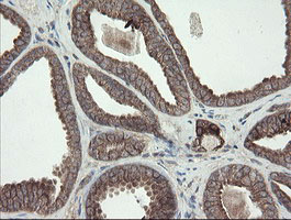 DPH2 Antibody - IHC of paraffin-embedded Carcinoma of Human prostate tissue using anti-DPH2 mouse monoclonal antibody.