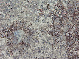 DPH2 Antibody - IHC of paraffin-embedded Adenocarcinoma of Human ovary tissue using anti-DPH2 mouse monoclonal antibody.