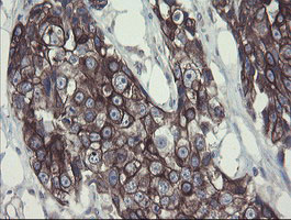 DPH2 Antibody - IHC of paraffin-embedded Adenocarcinoma of Human breast tissue using anti-DPH2 mouse monoclonal antibody.