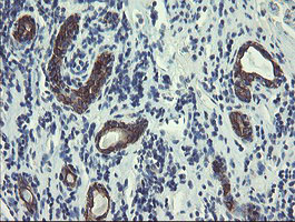 DPH2 Antibody - IHC of paraffin-embedded Carcinoma of Human kidney tissue using anti-DPH2 mouse monoclonal antibody.