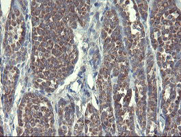DPH2 Antibody - IHC of paraffin-embedded Carcinoma of Human thyroid tissue using anti-DPH2 mouse monoclonal antibody.