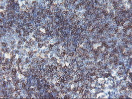 DPH2 Antibody - IHC of paraffin-embedded Human lymphoma tissue using anti-DPH2 mouse monoclonal antibody.